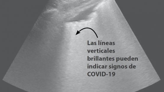 Ecografía covid 19
