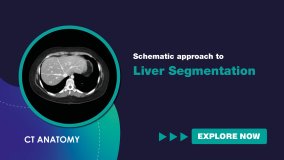 Schematic Approach to Liver Segmentation (Spanish)