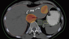 tumour-ch