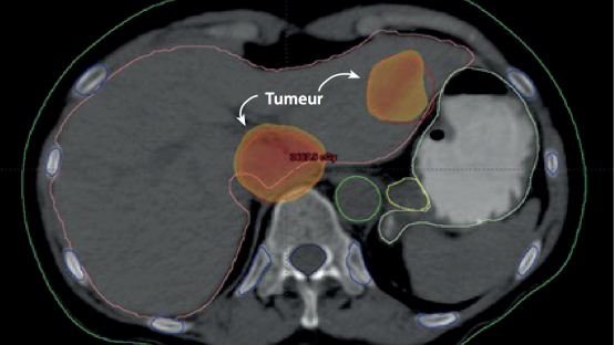 tumor_fr