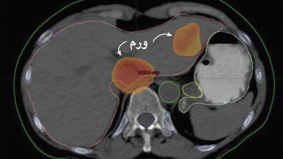 tumour-ar